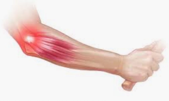 Lateral Elbow Pain